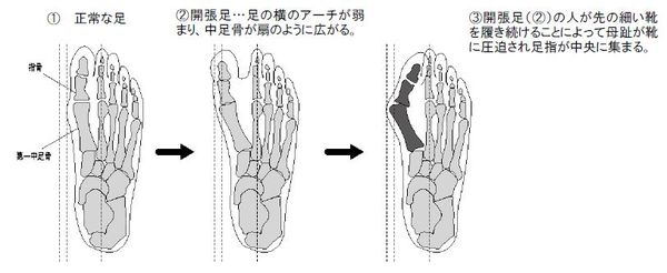 外反母趾説明