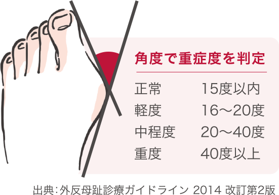 角度で重症度を判定